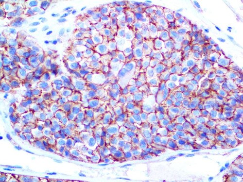 C of Melanoma / KBA.62 on an FFPE Melanoma Tissue